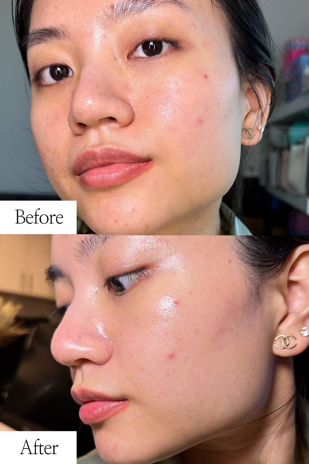 a woman with acne on her face